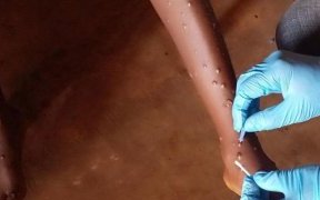 Mpox&nbsp;: l’OMS approuve le premier test de diagnostic pour une utilisation en situation d’urgence