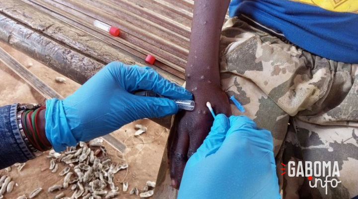 Mpox en Afrique&nbsp;: les enfants particulièrement menacés par la nouvelle variante