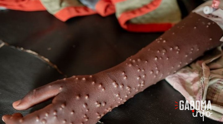 Mpox&nbsp;: l’OMS donne son feu vert au vaccin de Bavarian Nordic pour les adolescents