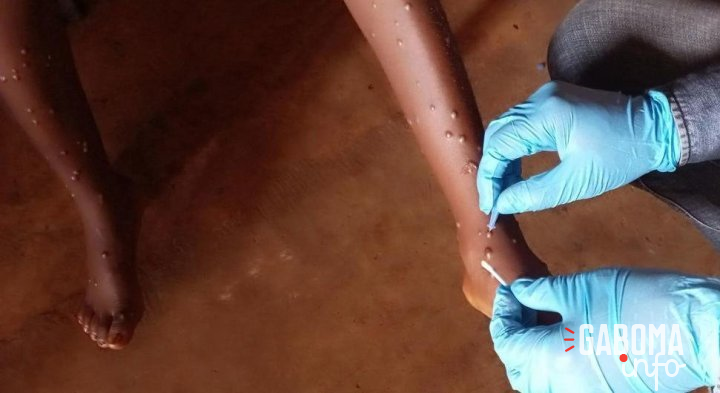 Mpox&nbsp;: l’OMS approuve le premier test de diagnostic pour une utilisation en situation d’urgence