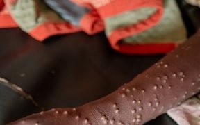 Mpox&nbsp;: l’OMS donne son feu vert au vaccin de Bavarian Nordic pour les adolescents